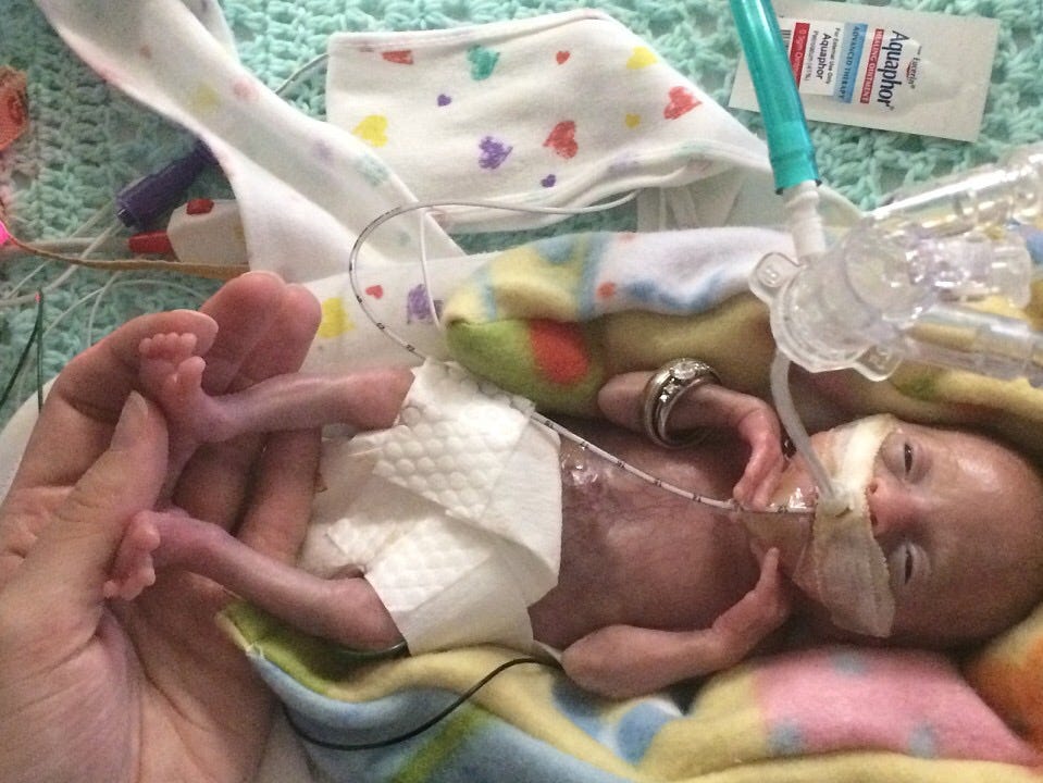 25 week old premature baby